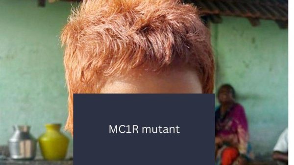 भारतीय लड़की के लाल बालों के पीछे दुर्लभ जीन की पहचान CCMB वैज्ञानिकों ने की